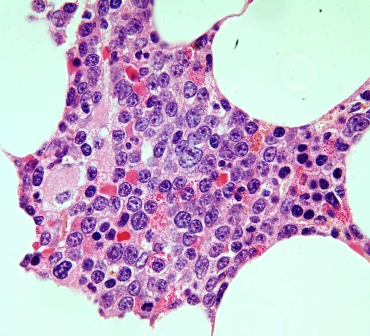 Figure 4. Bone marrow biopsy. Blasts are seen amid megakaryotic dyslasia (100x).